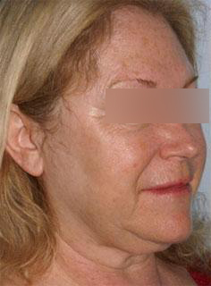 Facelift Before & After Image