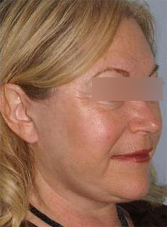 Facelift Before & After Image