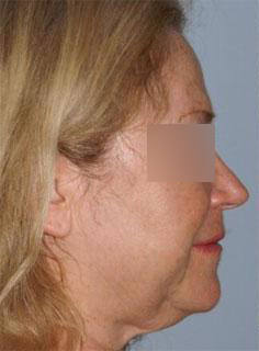 Facelift Before & After Image