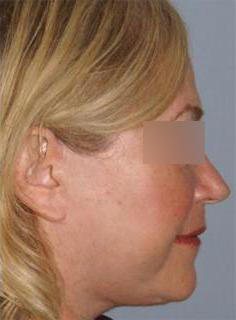 Facelift Before & After Image