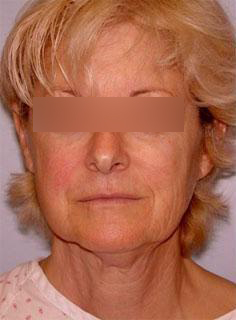 Facelift Before & After Image