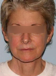 Facelift Before & After Image