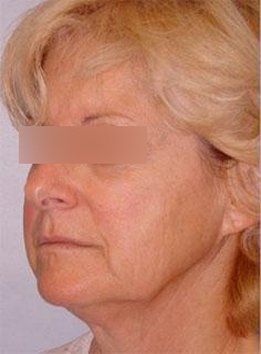 Facelift Before & After Image