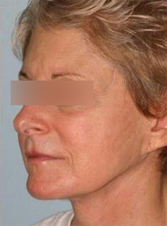 Facelift Before & After Image