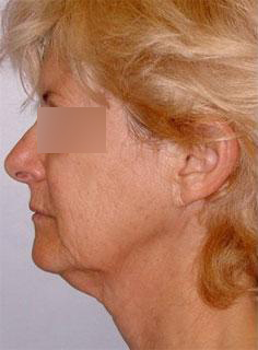 Facelift Before & After Image