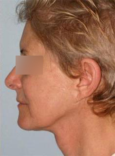 Facelift Before & After Image