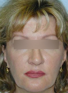 Facelift Before & After Image