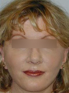 Facelift Before & After Image