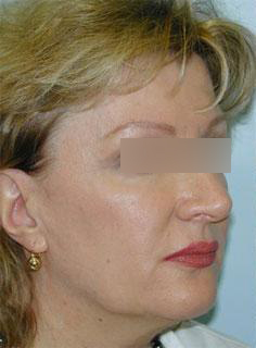 Facelift Before & After Image