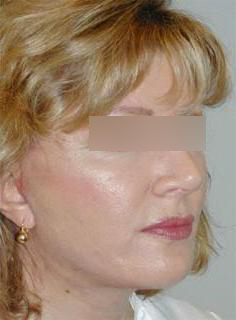 Facelift Before & After Image