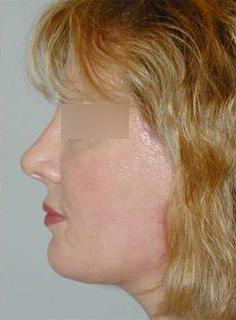 Facelift Before & After Image