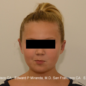 Otoplasty Before & After Image