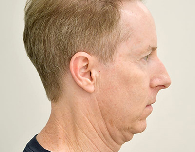 Rhinoplasty Before & After Image