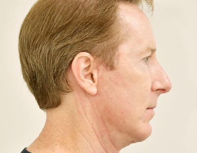 Rhinoplasty Before & After Image