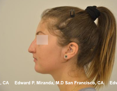 Rhinoplasty Before & After Image