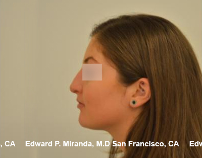 Rhinoplasty Before & After Image