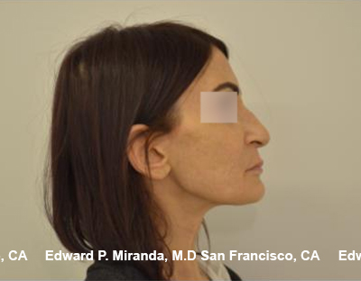 Rhinoplasty Before & After Image