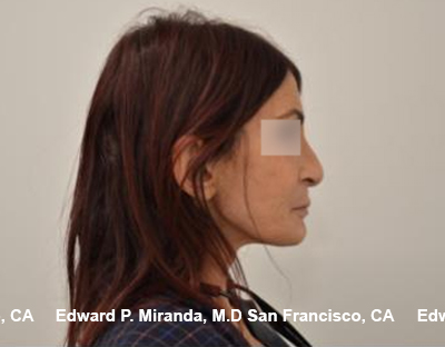 Rhinoplasty Before & After Image