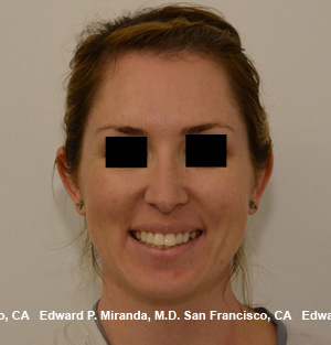 Rhinoplasty Before & After Image