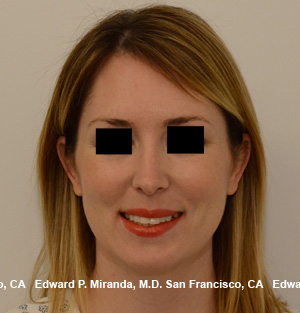 Rhinoplasty Before & After Image