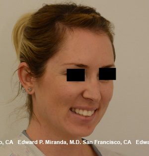 Rhinoplasty Before & After Image