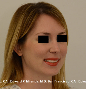 Rhinoplasty Before & After Image