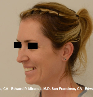 Rhinoplasty Before & After Image