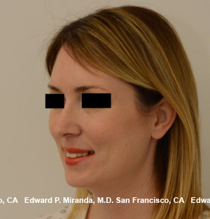 Rhinoplasty Before & After Image