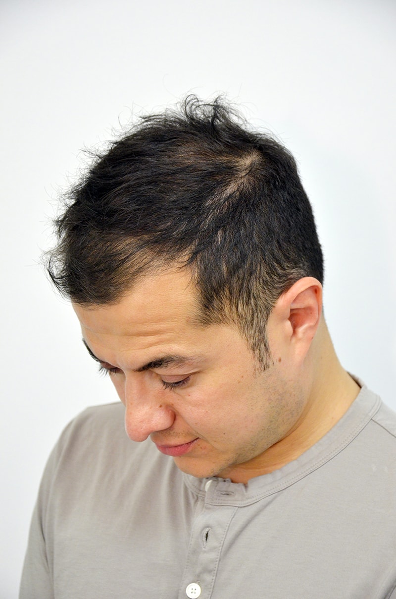 Hair Transplant in Turkey Cost Calculator - Check Exact Cost