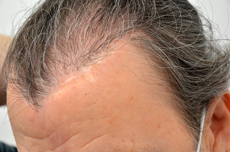 Hair Transplant Before & After Image