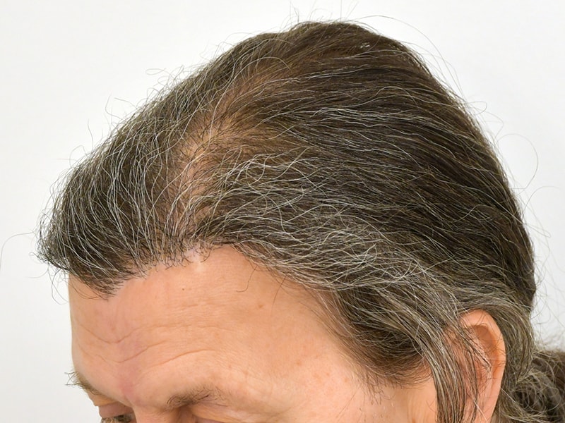 Hair Transplant Before & After Image