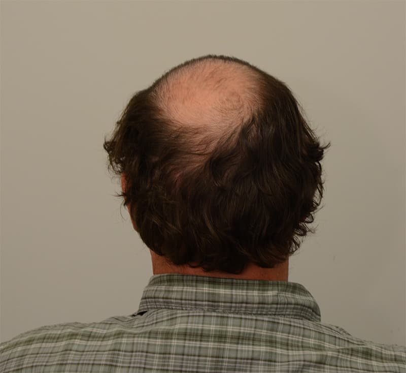 Hair Transplant Before & After Image