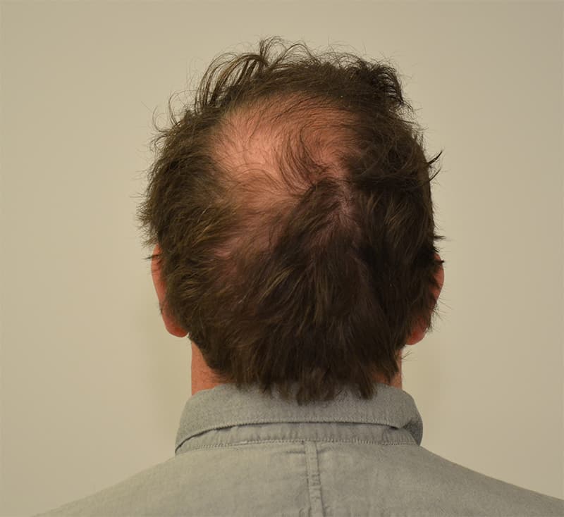 Hair Transplant Before & After Image