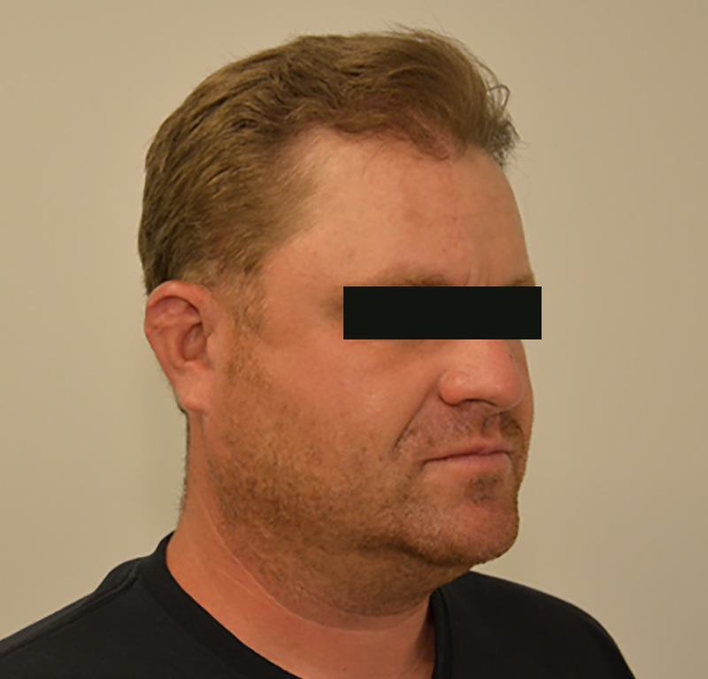 Hair Transplant Before & After Image