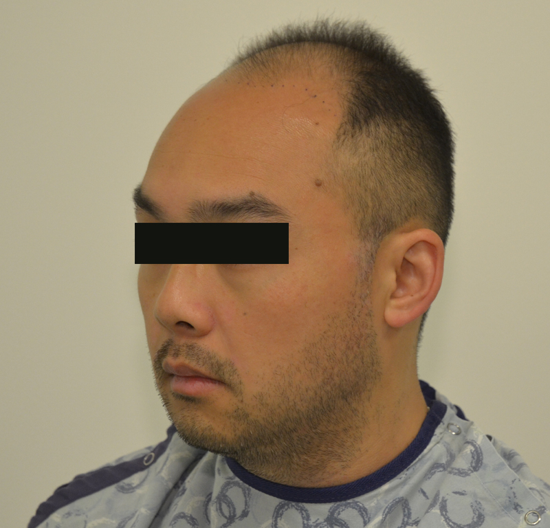 Hair Transplant Before & After Image