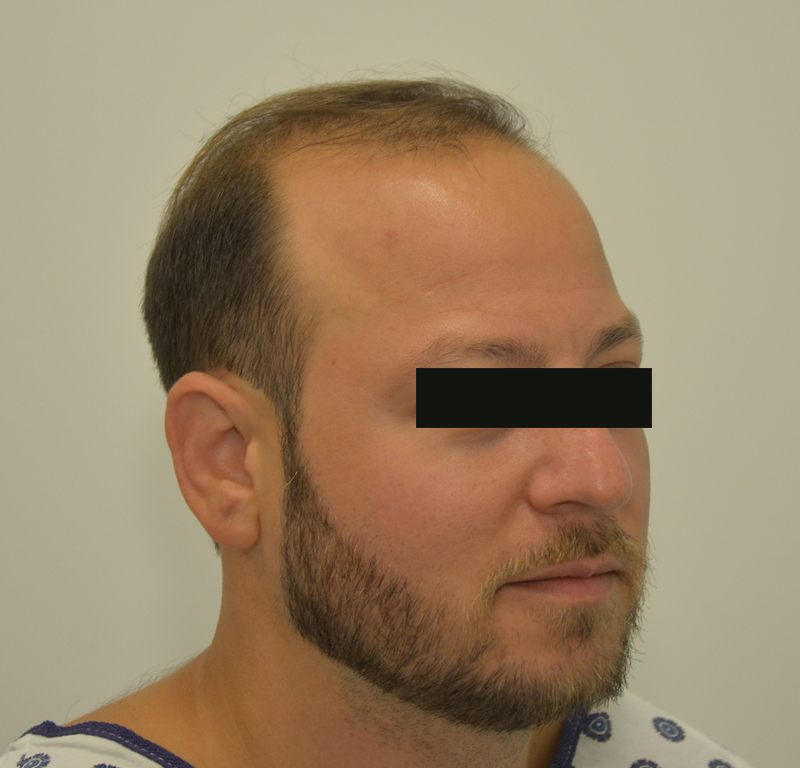 Hair Transplant Before & After Image