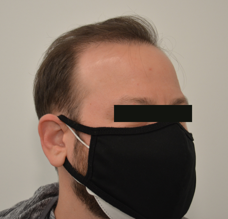 Hair Transplant Before & After Image