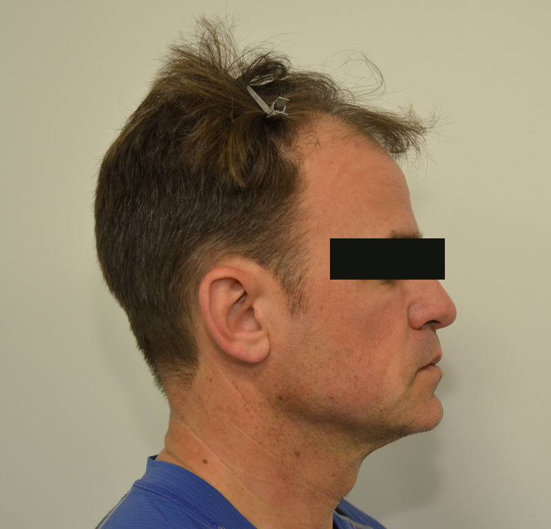 Hair Transplant Before & After Image