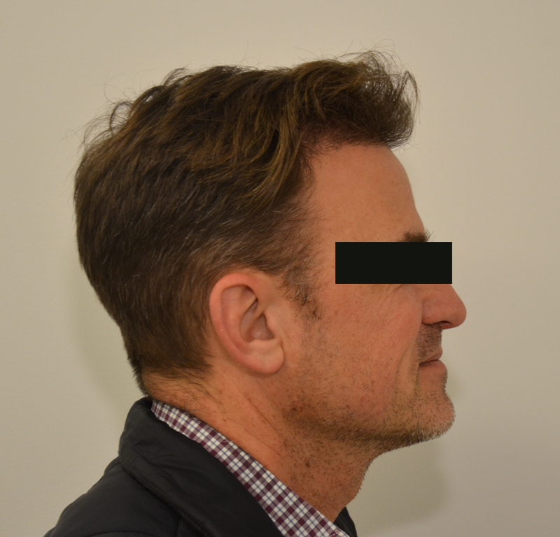 Hair Transplant Before & After Image