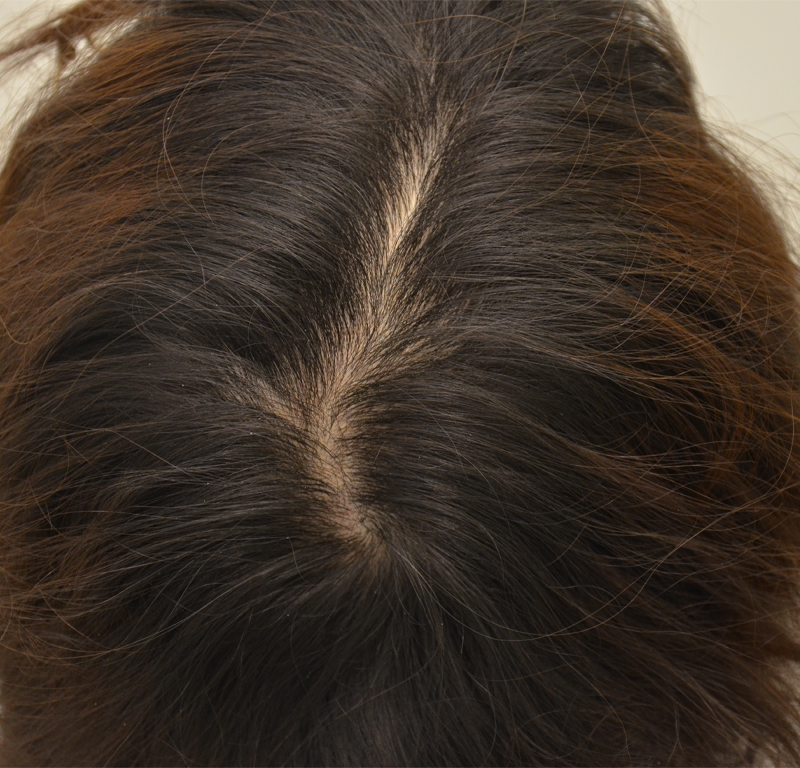 Hair Transplant Before & After Image