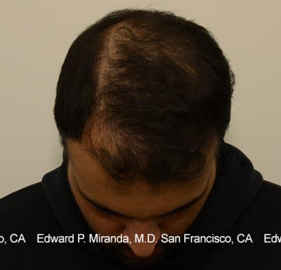 Hair Transplant Before & After Image