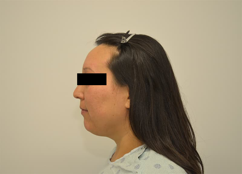 Hairline Lowering Before & After Image