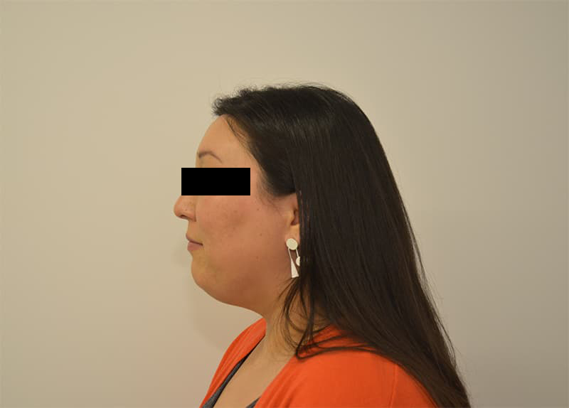 Hairline Lowering Before & After Image