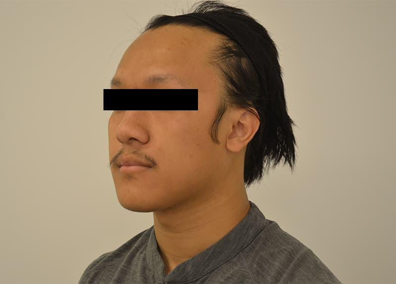 Hairline Lowering Before & After Image