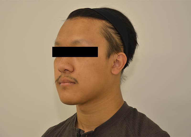 Hairline Lowering Before & After Image