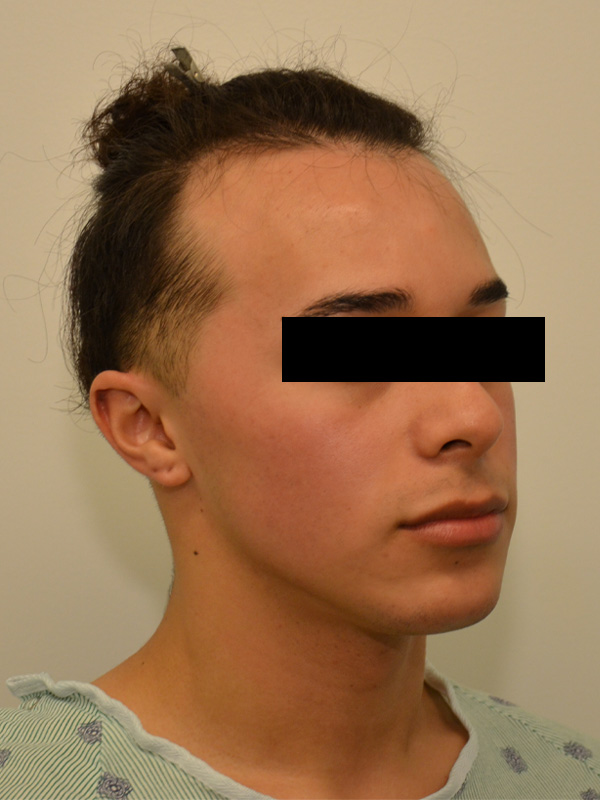 Hairline Lowering Before & After Image