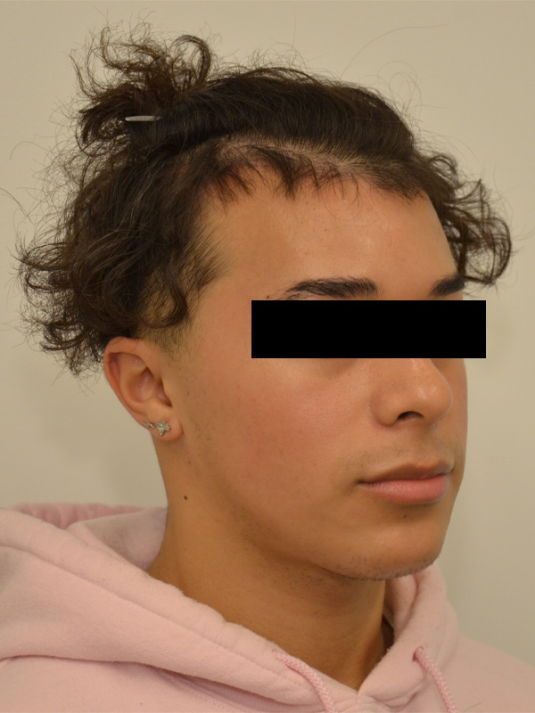 Hairline Lowering Before & After Image