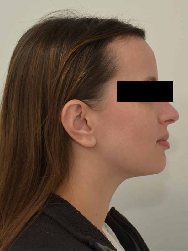 Hairline Lowering Before & After Image