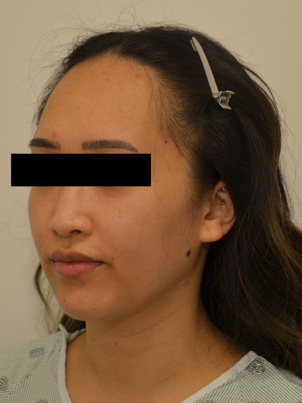 Hairline Lowering Before & After Image