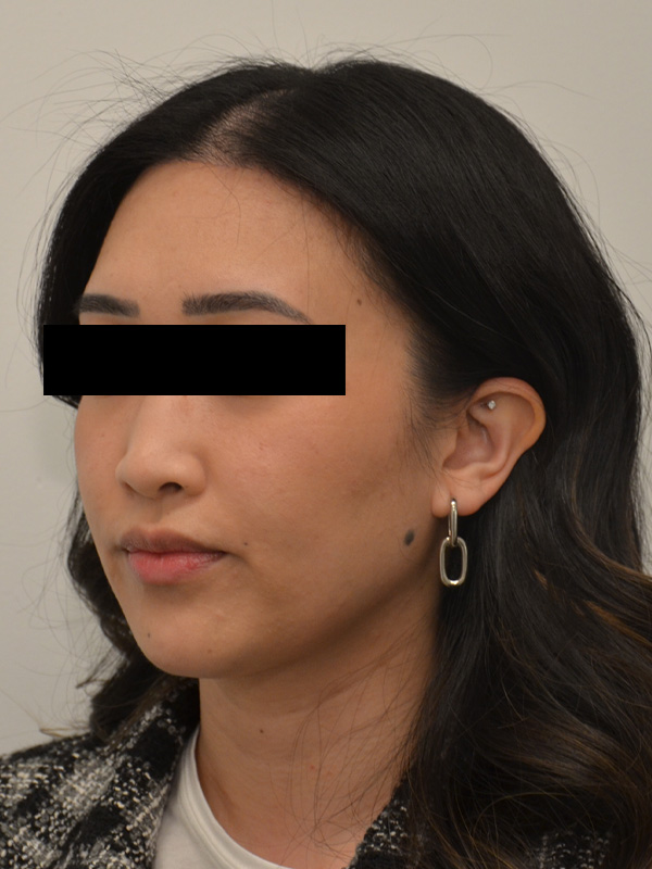 Hairline Lowering Before & After Image